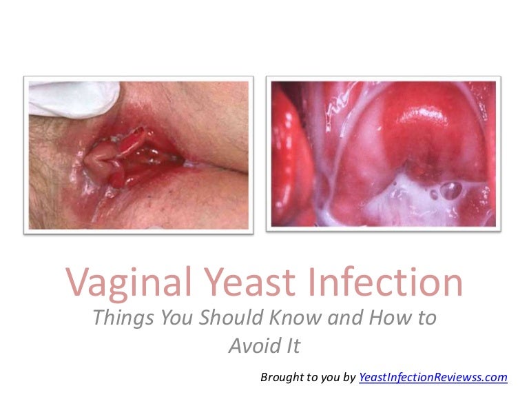 Can you die from a yeast infection